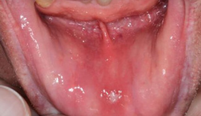 Mouth ulcer