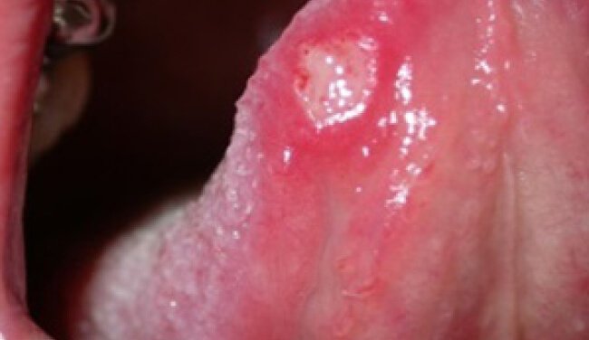 Mouth ulcer