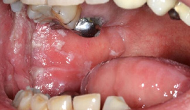 Oral mucosa hyperkeratosis