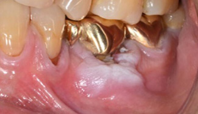 Oral mucosa hyperkeratosis