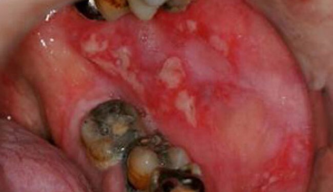 Oral mucositis