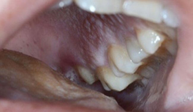 Oral mucositis
