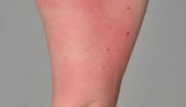 Photosensitivity