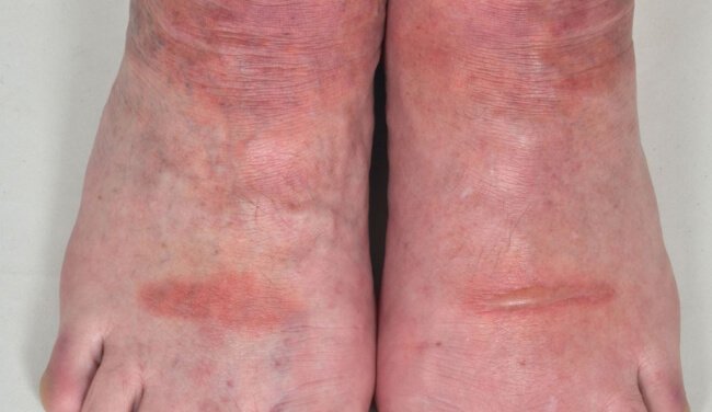 Photosensitivity