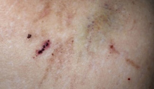 Pruritus
