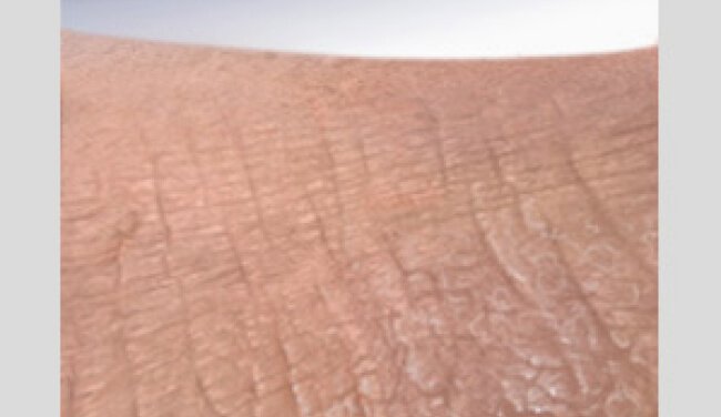 Pruritus