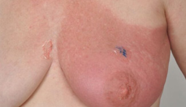 Radiodermatitis