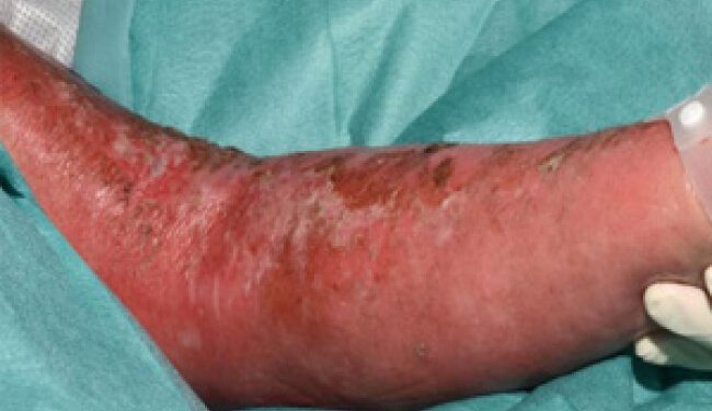 Radiodermatitis