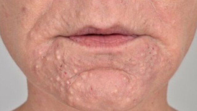 Sebaceous adenoma