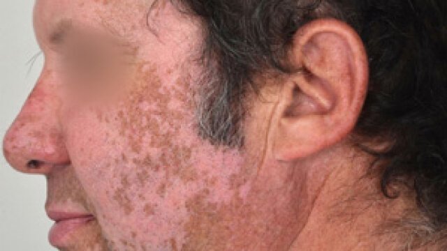 Skin hypopigmentation