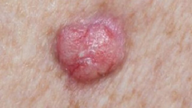 Squamous cell carcinoma