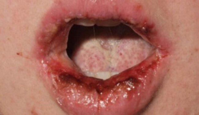 Stevens-Johnson syndrome