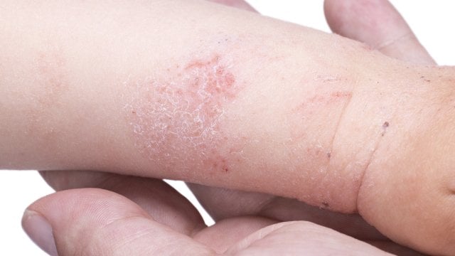 Atopy Panel Quiz of the month: Atopy | L'Oreal Dermatological Beauty