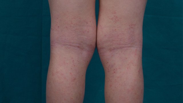 Dermacademy Challenge – Clinical Case #7 – Pr. Gelmetti