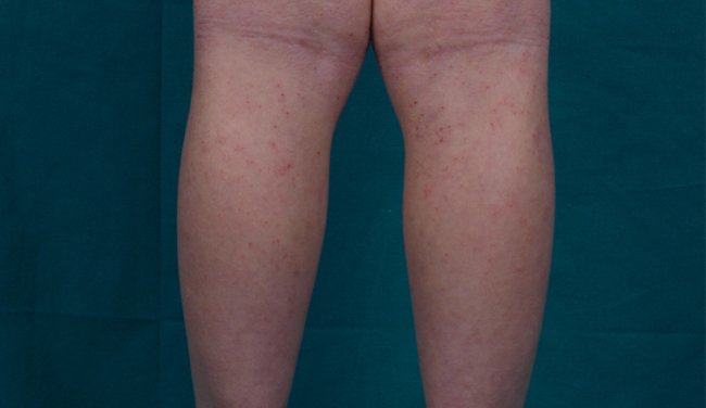 Dermacademy Challenge - Clinical Case #7 - Prof. Gelmetti