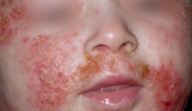 Misleading Diagnosis: Atopy