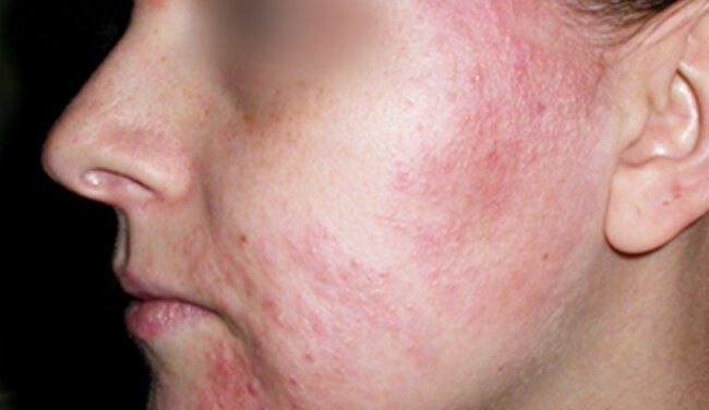Misleading Diagnosis: Atopy