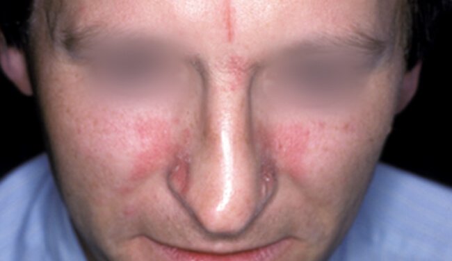 Misleading Diagnosis: Atopy