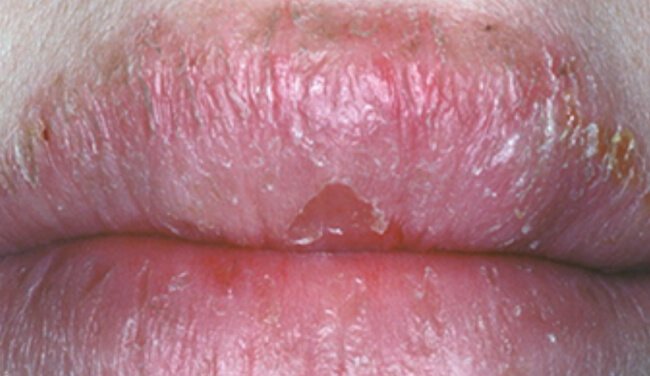 Misleading Diagnosis: Atopy