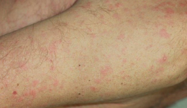 Dermacademy Challenge - Clinical Case #5 - Pr. Marie-Sylvie Doutre