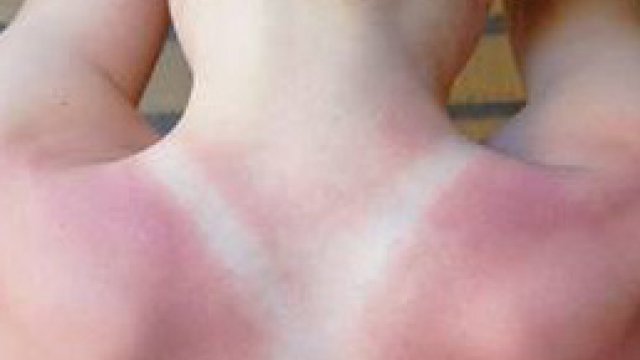 Quiz of the month: Photoprotection