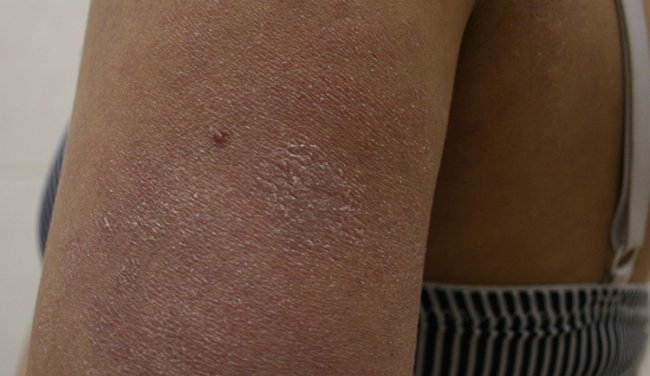 Dermacademy Challenge - Clinical Case #6 - Pr. Zaslavsky