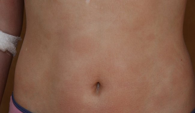 Dermacademy Challenge - Clinical Case #6 - Pr. Zaslavsky
