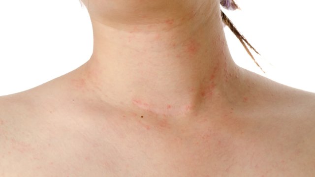 Quiz of the month: Allergy