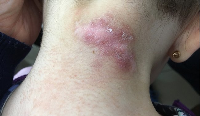 Dermacademy Challenge - Clinical Case #3 - Pr. Zaslavsky