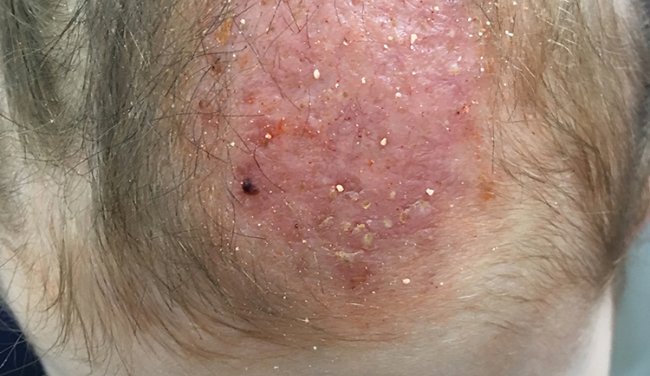 Dermacademy Challenge - Clinical Case #3 - Pr. Zaslavsky