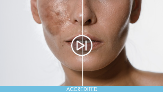 Hyperpigmentation Management Course