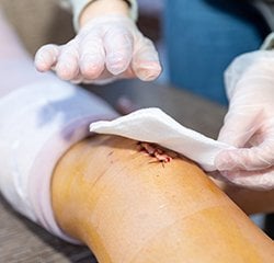 Clinical management of pigmentary disorders - Wound Healing