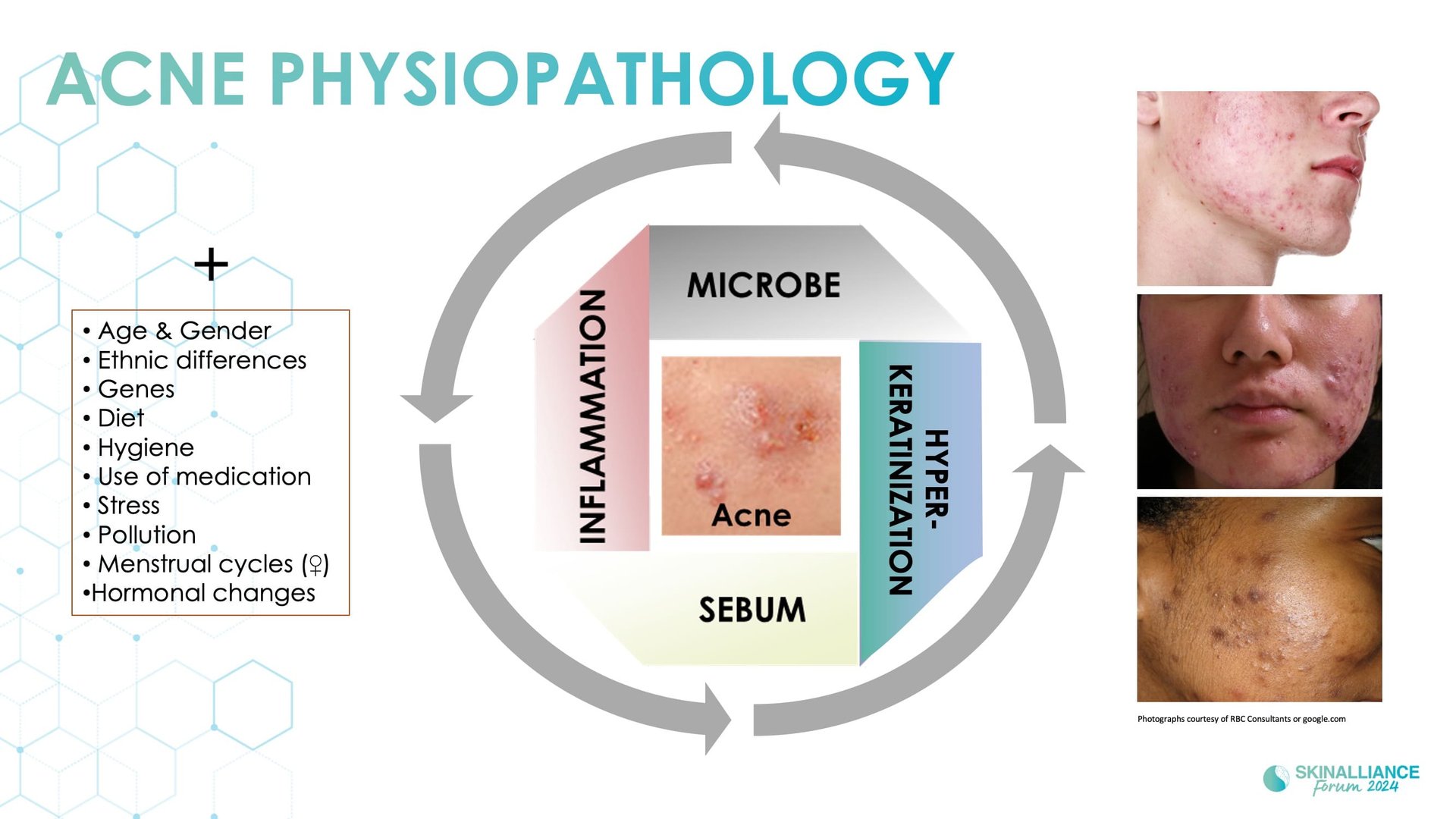 Biological events during various stages of acne