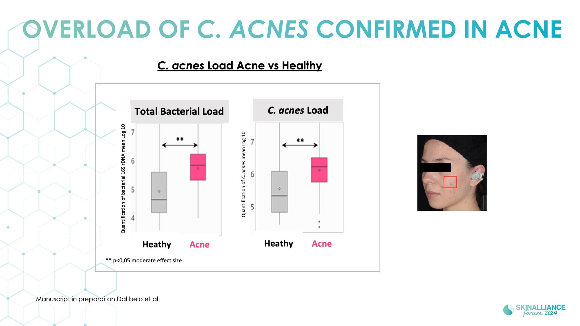 Biological events during various stages of acne