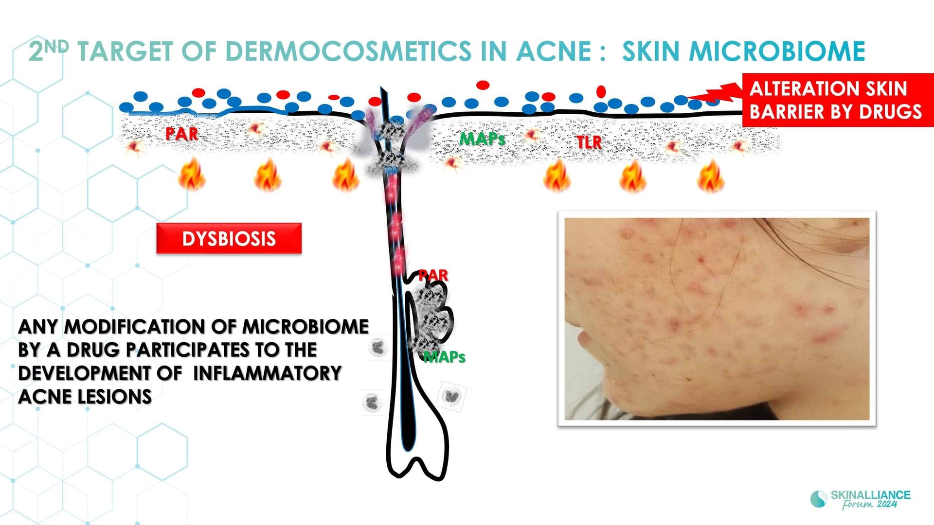 Acne and the role of dermocosmetics