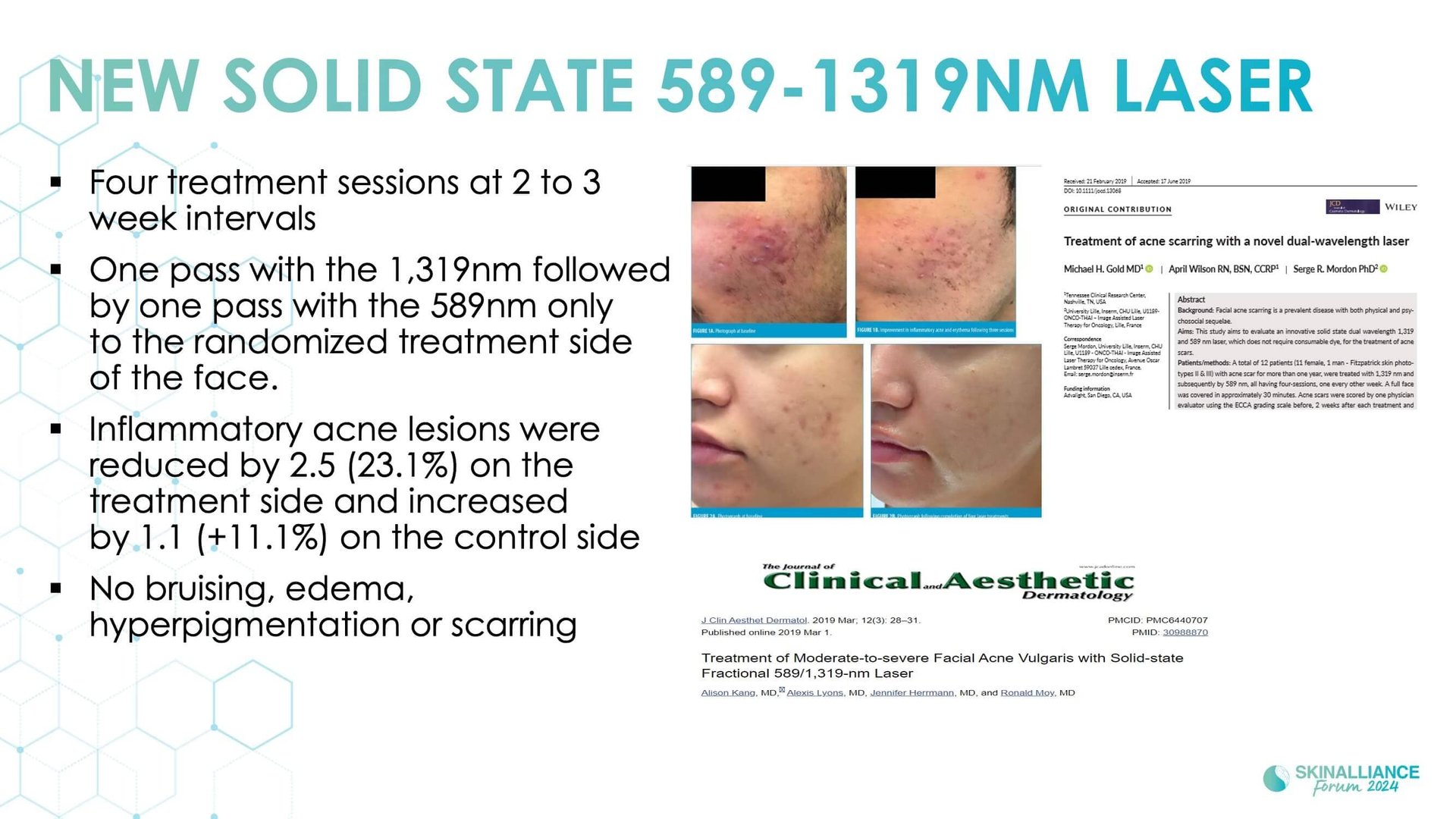 New devis treatments in acne