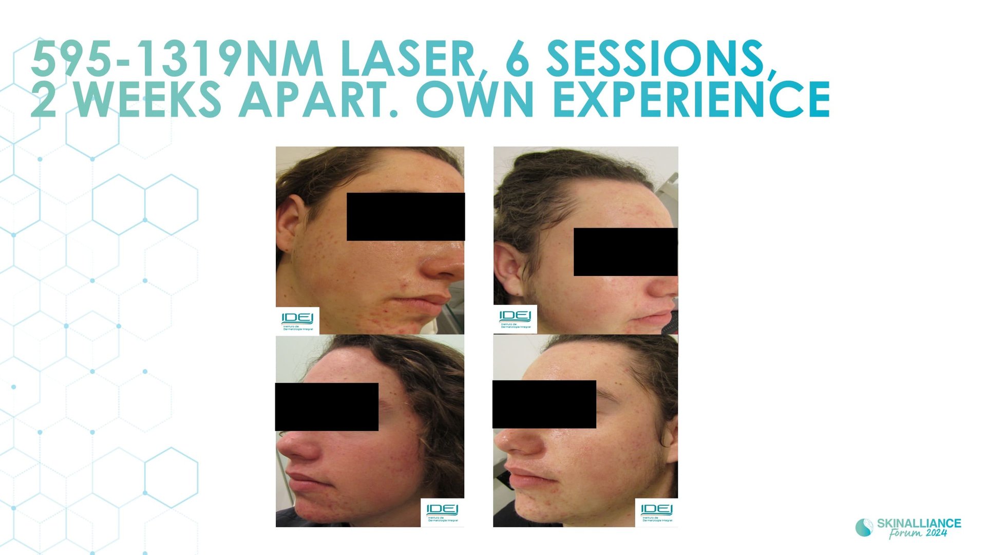 New devis treatments in acne