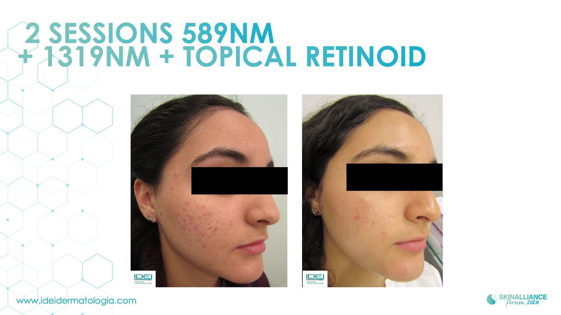 New devis treatments in acne