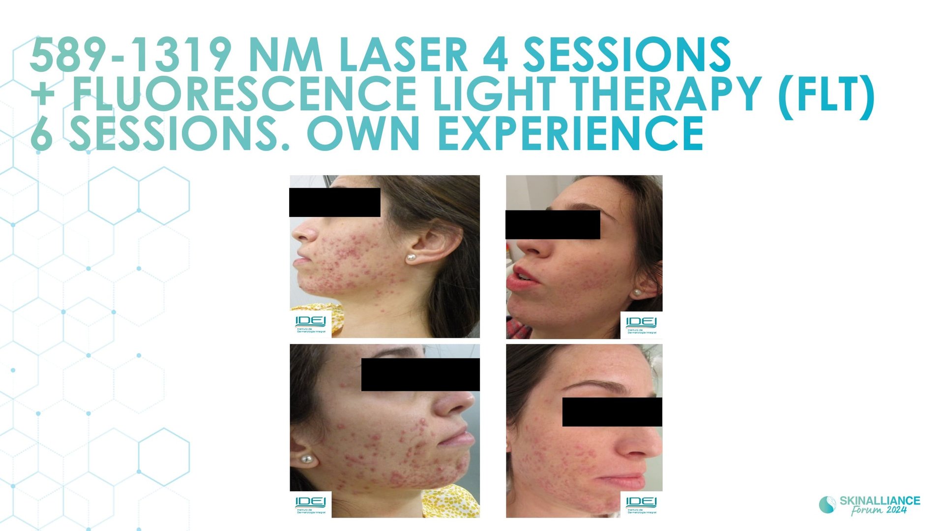 New devis treatments in acne