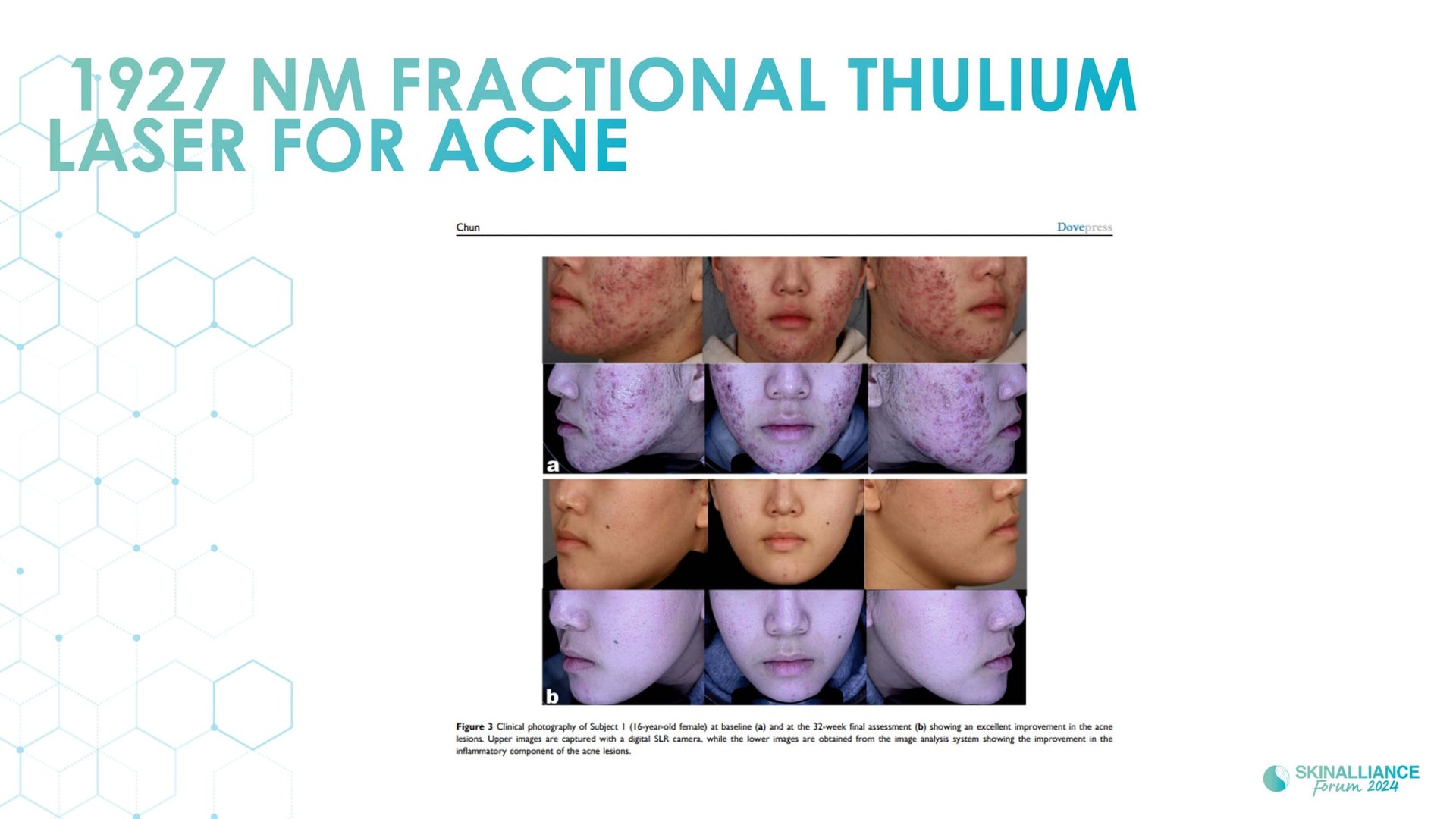 New devis treatments in acne