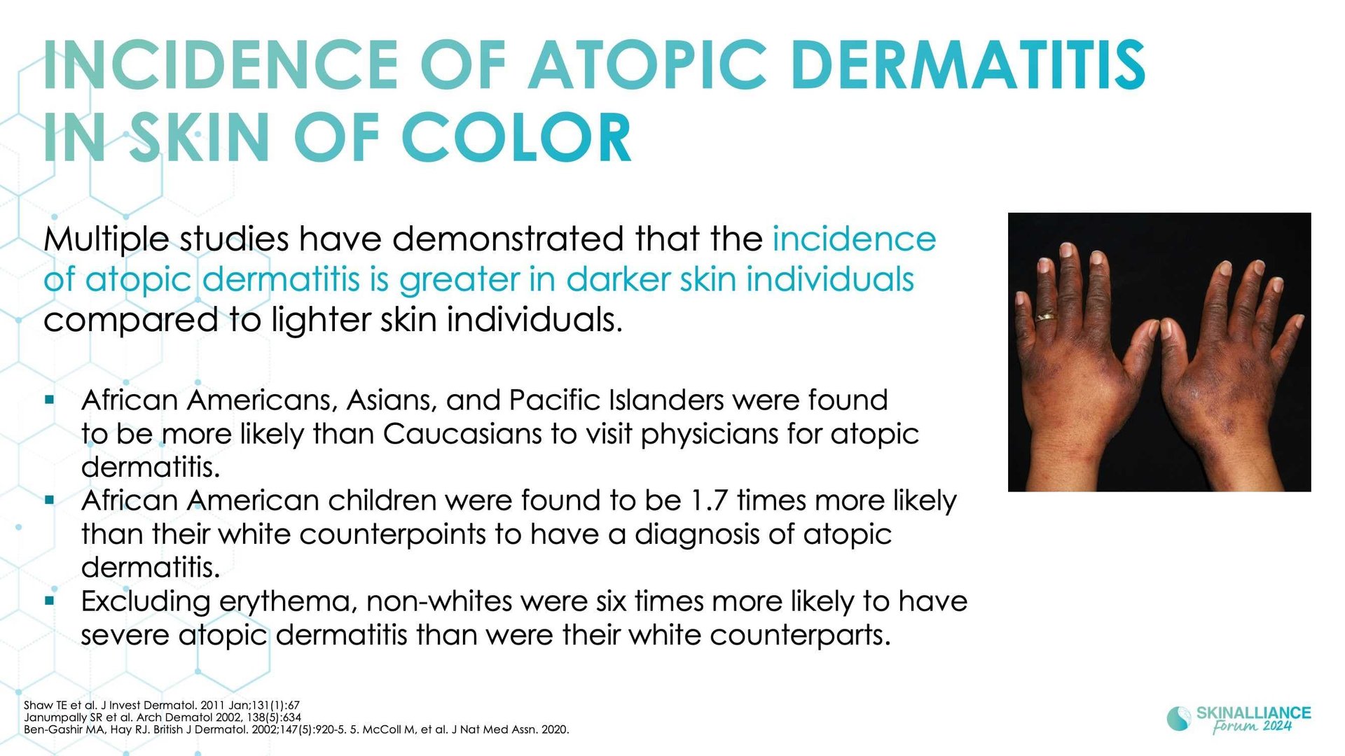 Racial/ethnic variations in skin barrier structure, function, and composition in dry, atopic skin