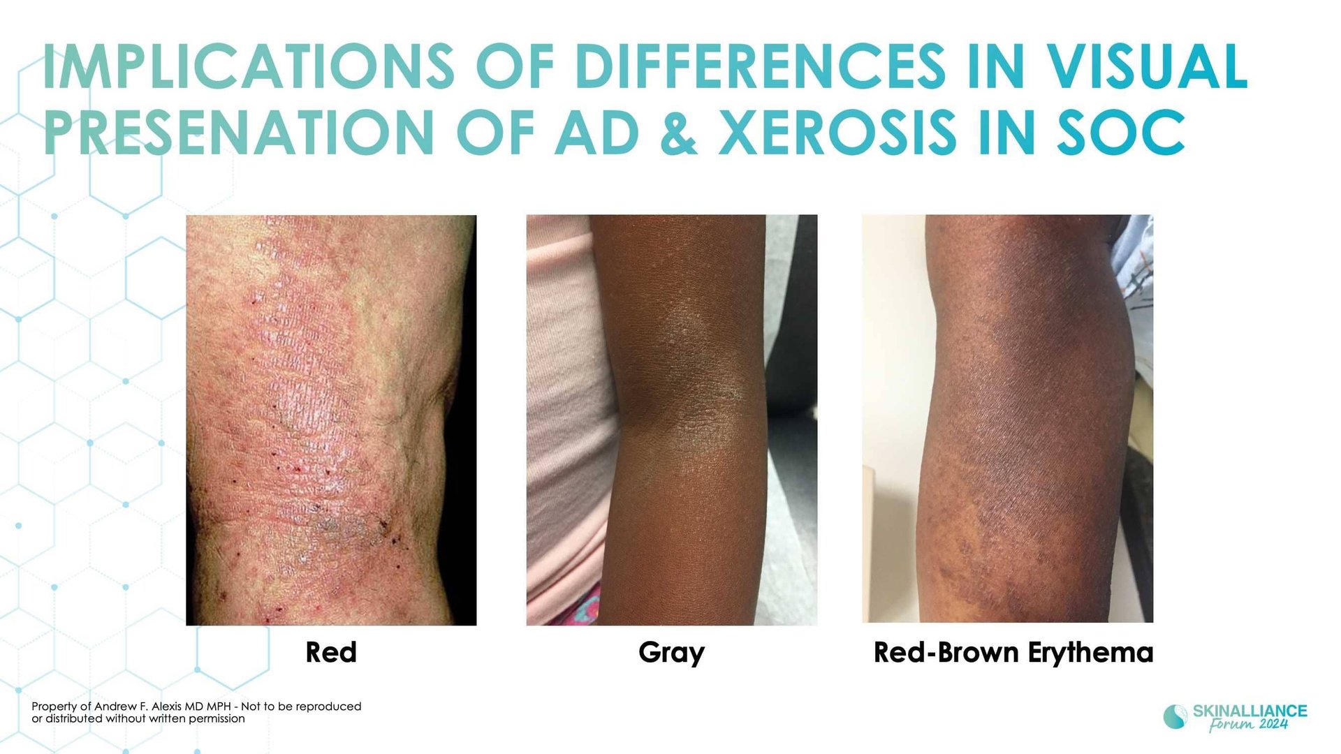 Racial/ethnic variations in skin barrier structure, function, and composition in dry, atopic skin