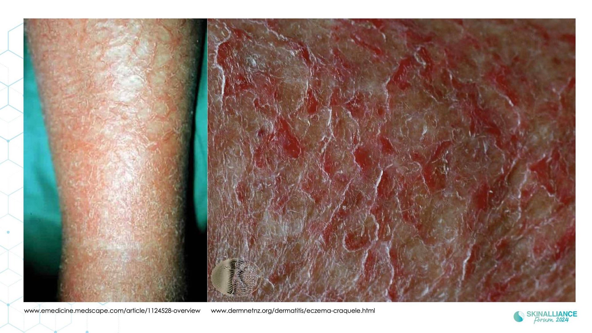 Mature xerosis alterations in barrier structure, function, and composition with age