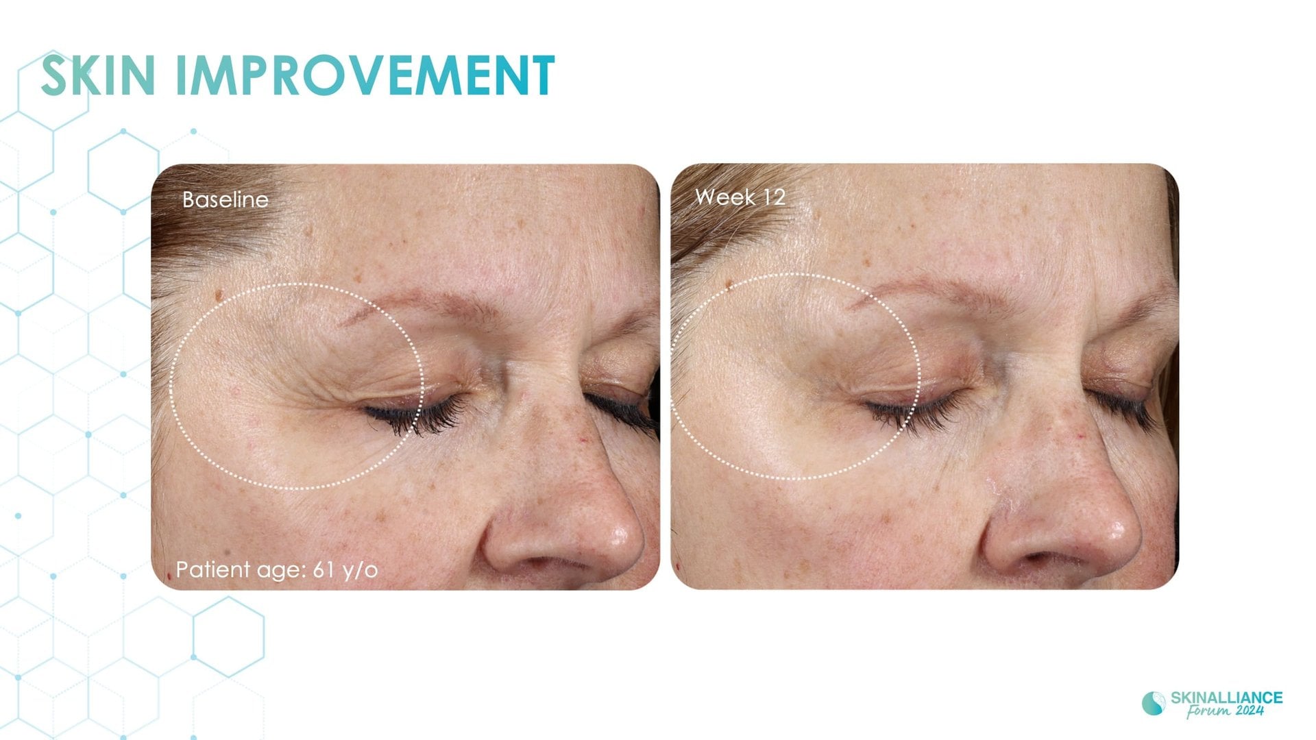 Exosomes and skin longevity