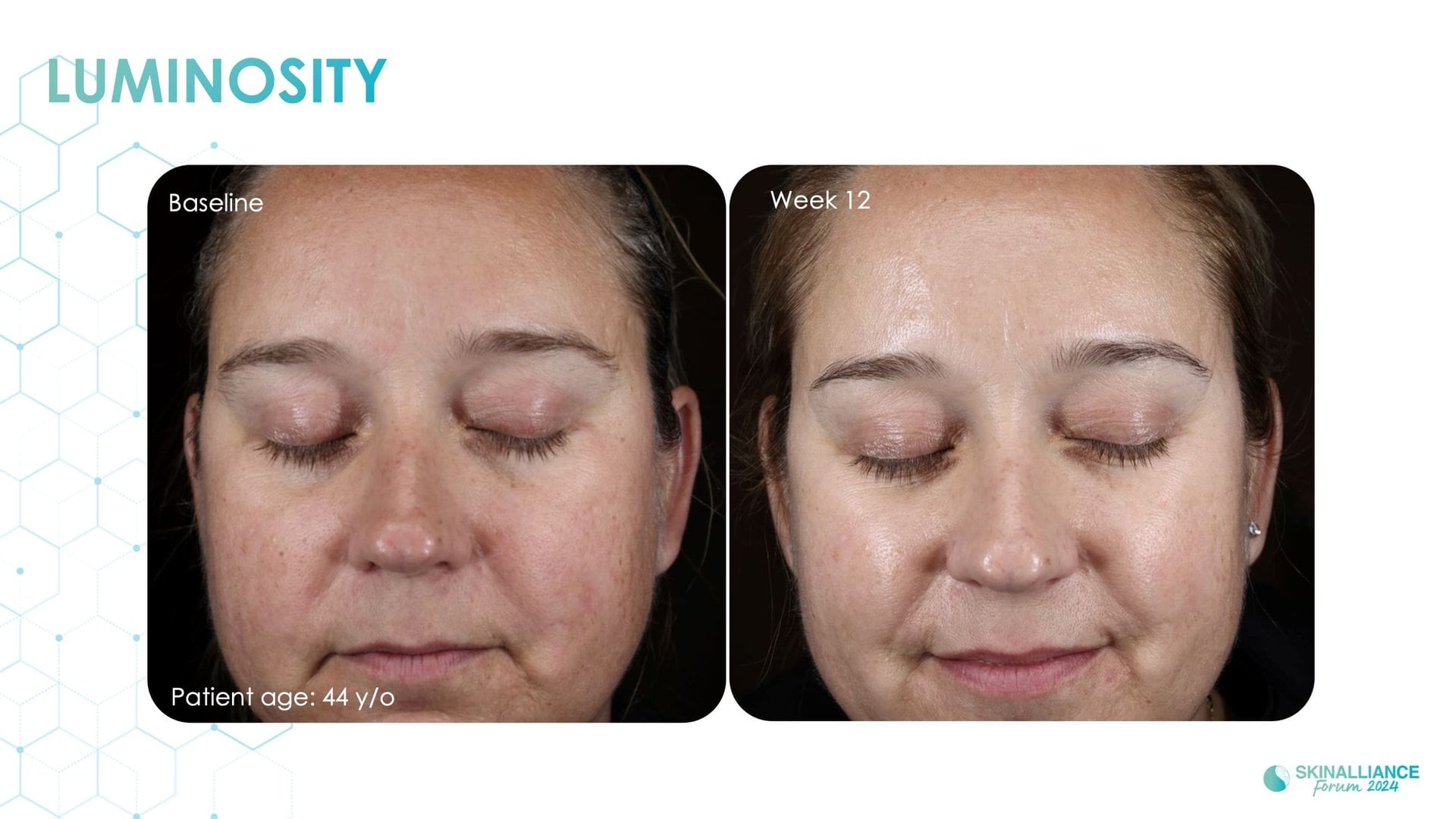 Exosomes and skin longevity
