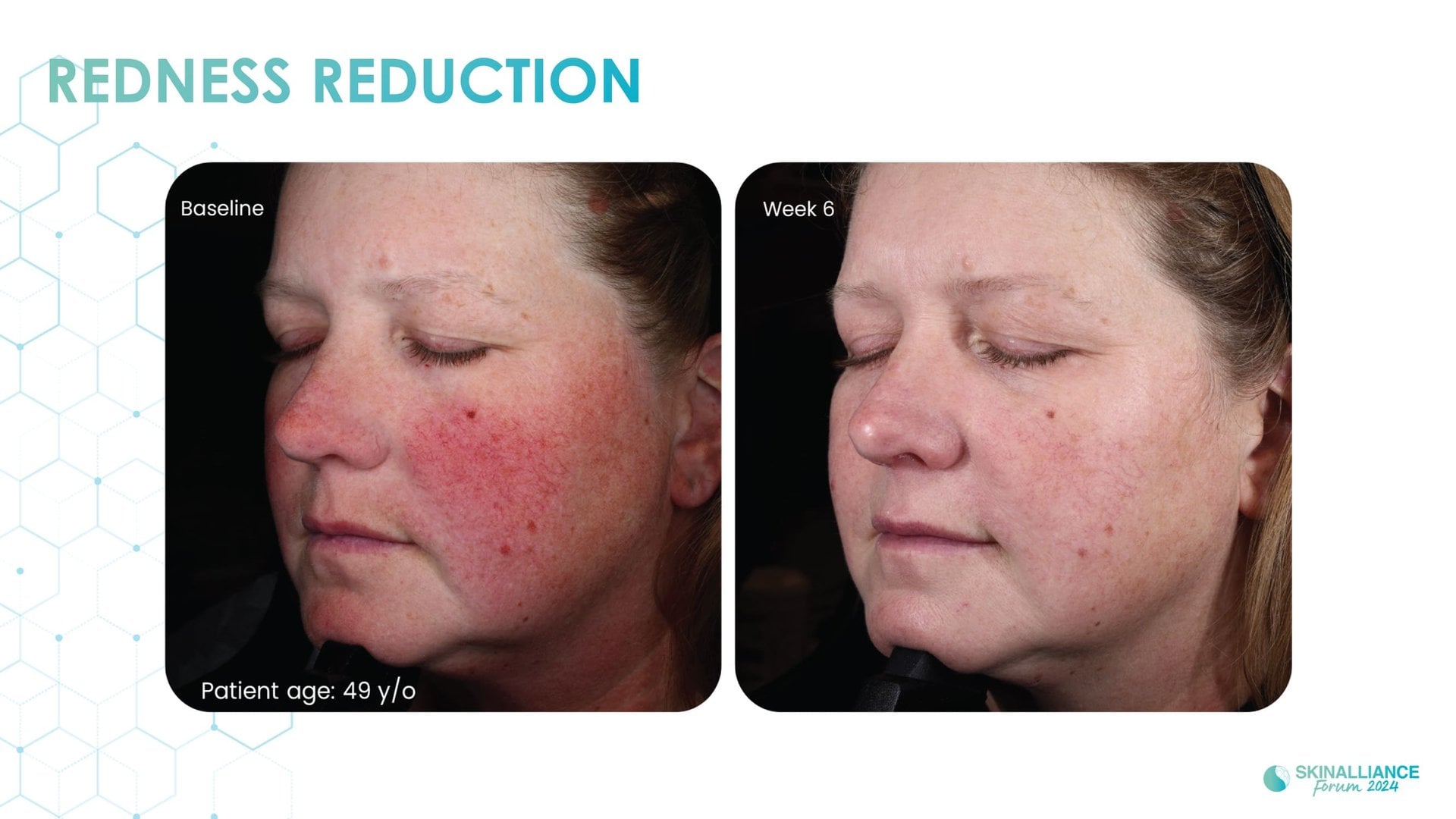 Exosomes and skin longevity