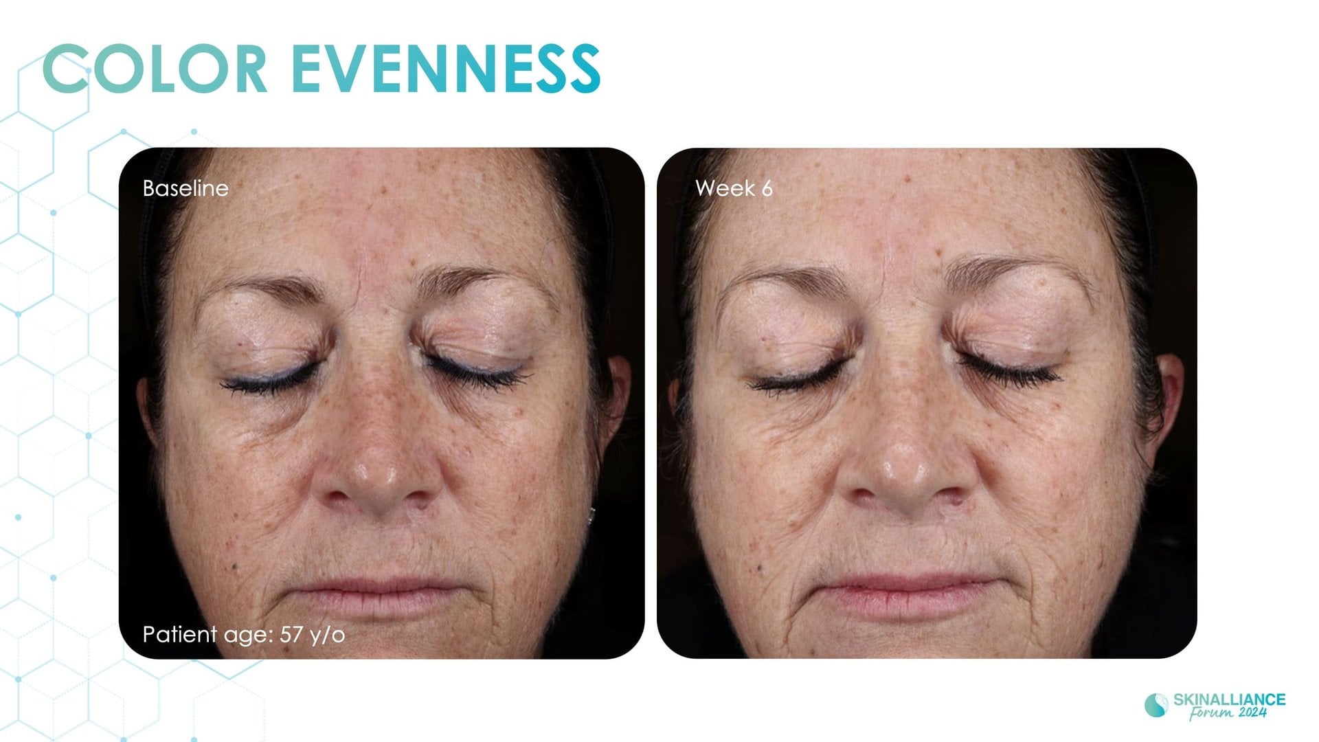 Exosomes and skin longevity