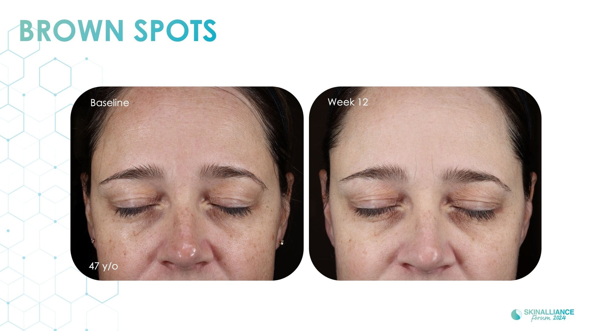 Exosomes and skin longevity