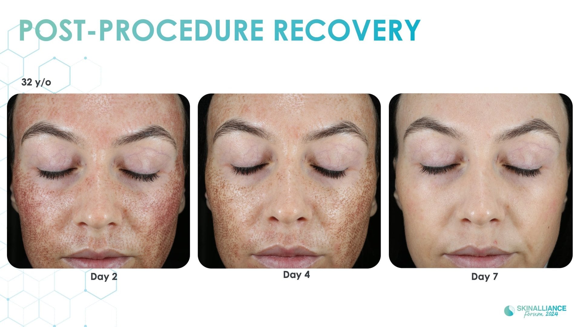 Exosomes and skin longevity