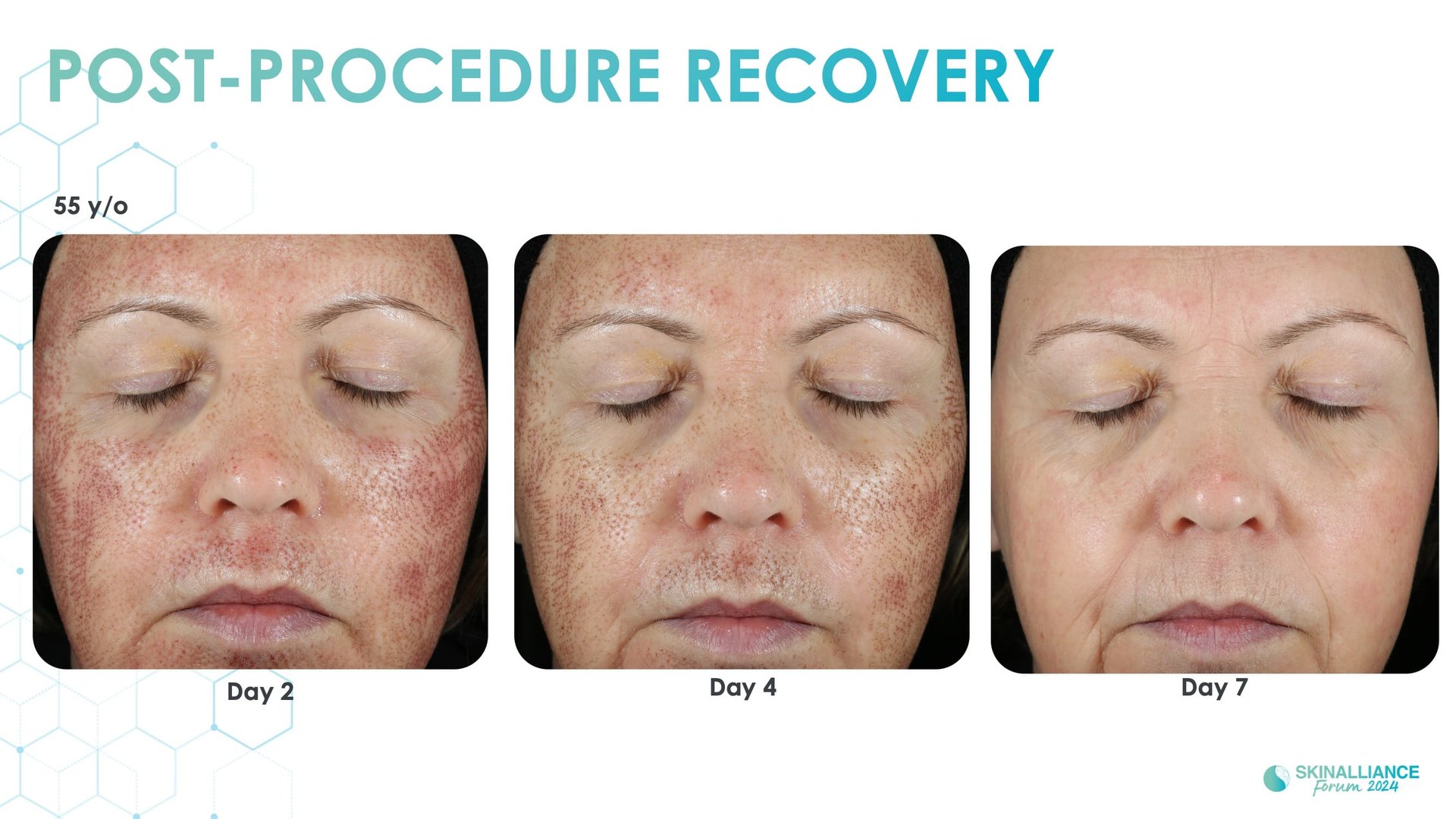 Exosomes and skin longevity